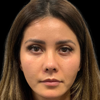 ethnic-rhinoplasty-after